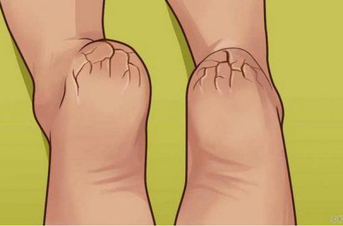 Якщо ви страждаєте від сухої шкіри на ступнях, обов’язково прочитайте цю статтю!