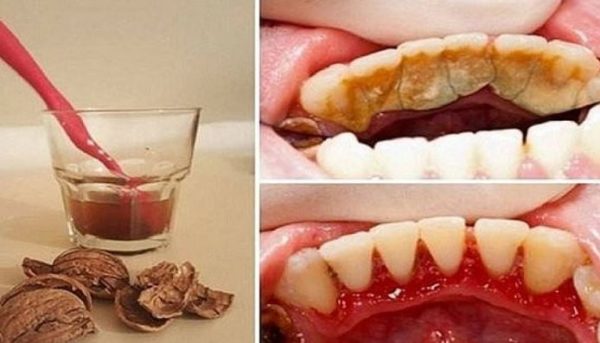 Корисно знати! Коричневий або жовтий наліт на зубах можна видалити вдома!