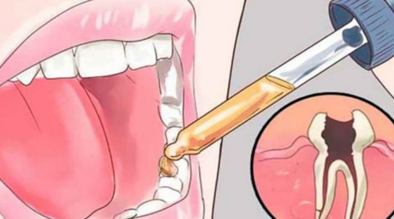 Стоматолог не расскажет: есть целых 12 способов снять зубную боль