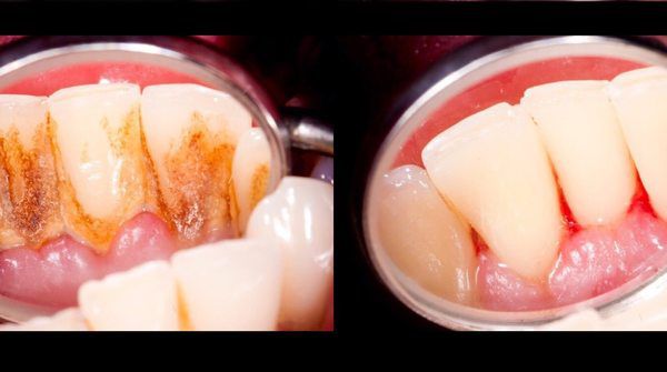 3 краплі – і зубний наліт зникне за один раз! Швидкий рецепт, як відбілити зуби!
